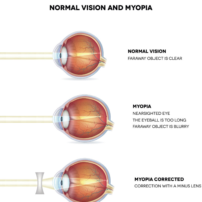 Activity 11 Optics Of The Human Eye